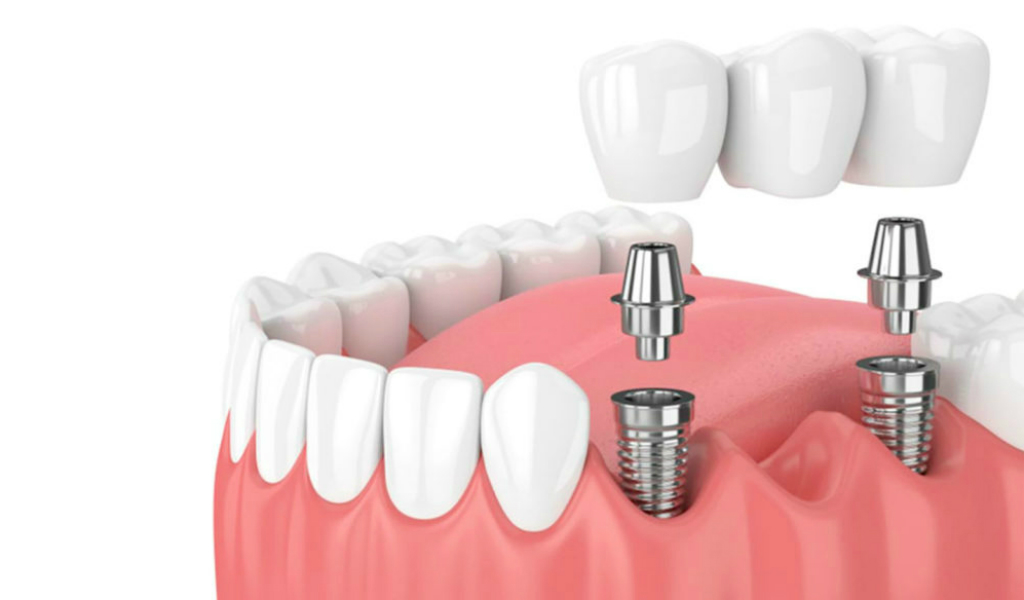 Implantologia Dental